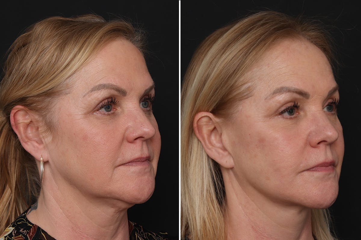 Facelift Before & After Gallery - Patient 651168 - Image 3