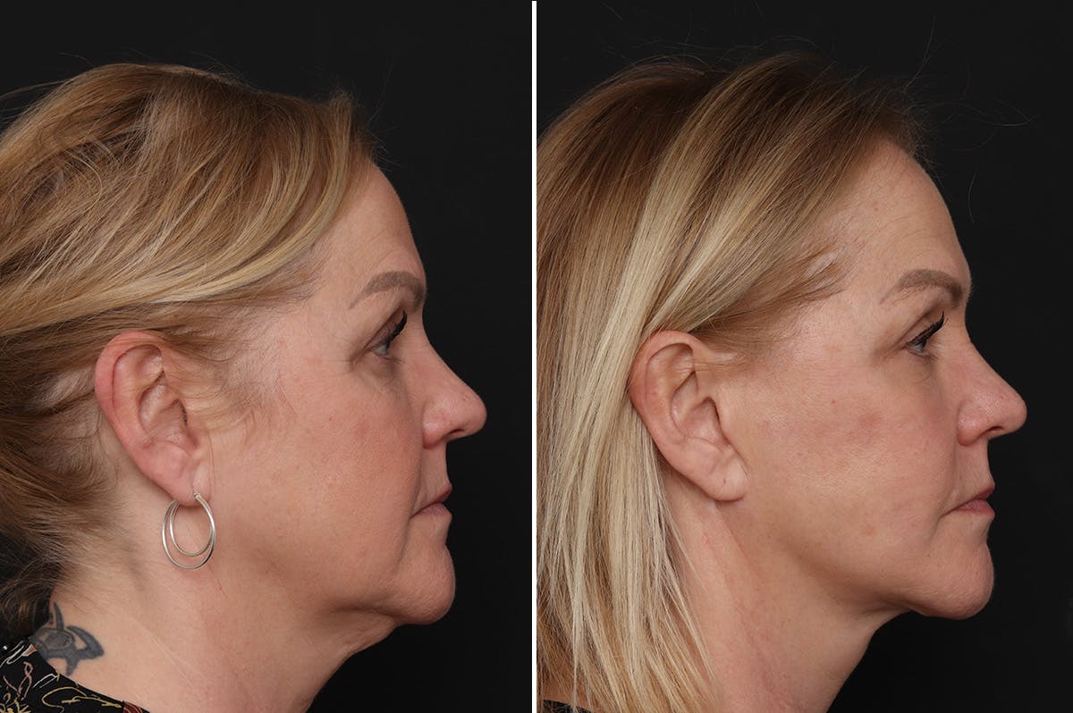 Facelift Before & After Gallery - Patient 651168 - Image 1