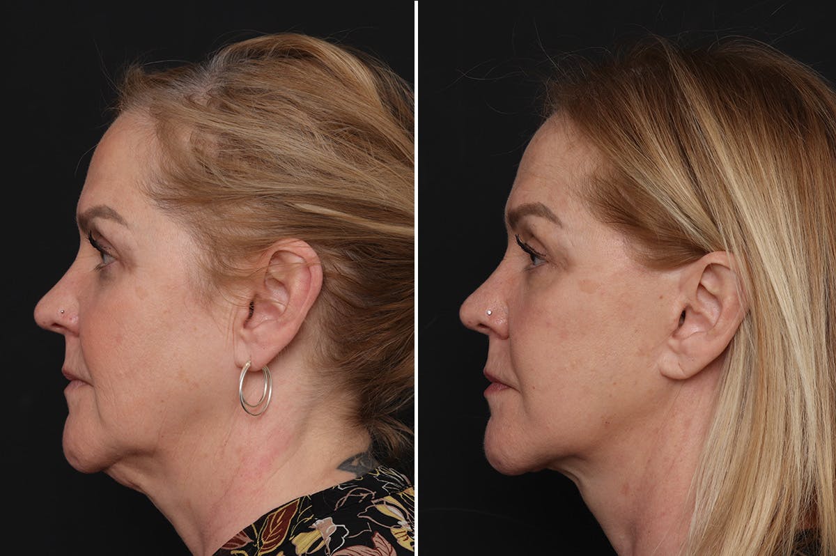 Facelift Before & After Gallery - Patient 651168 - Image 4