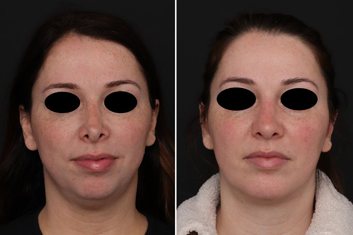 Chin Implants Before & After Gallery - Patient 222069 - Image 2
