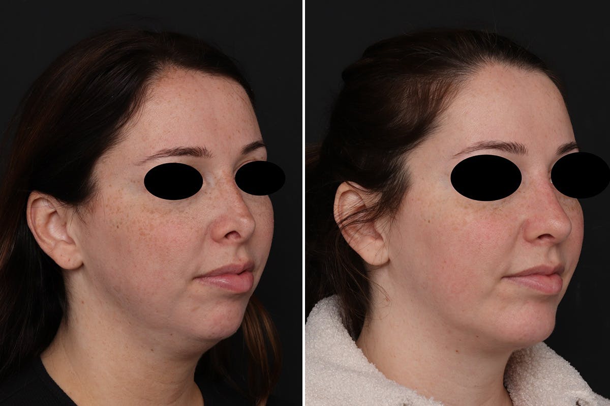 Chin Implants Before & After Gallery - Patient 222069 - Image 3