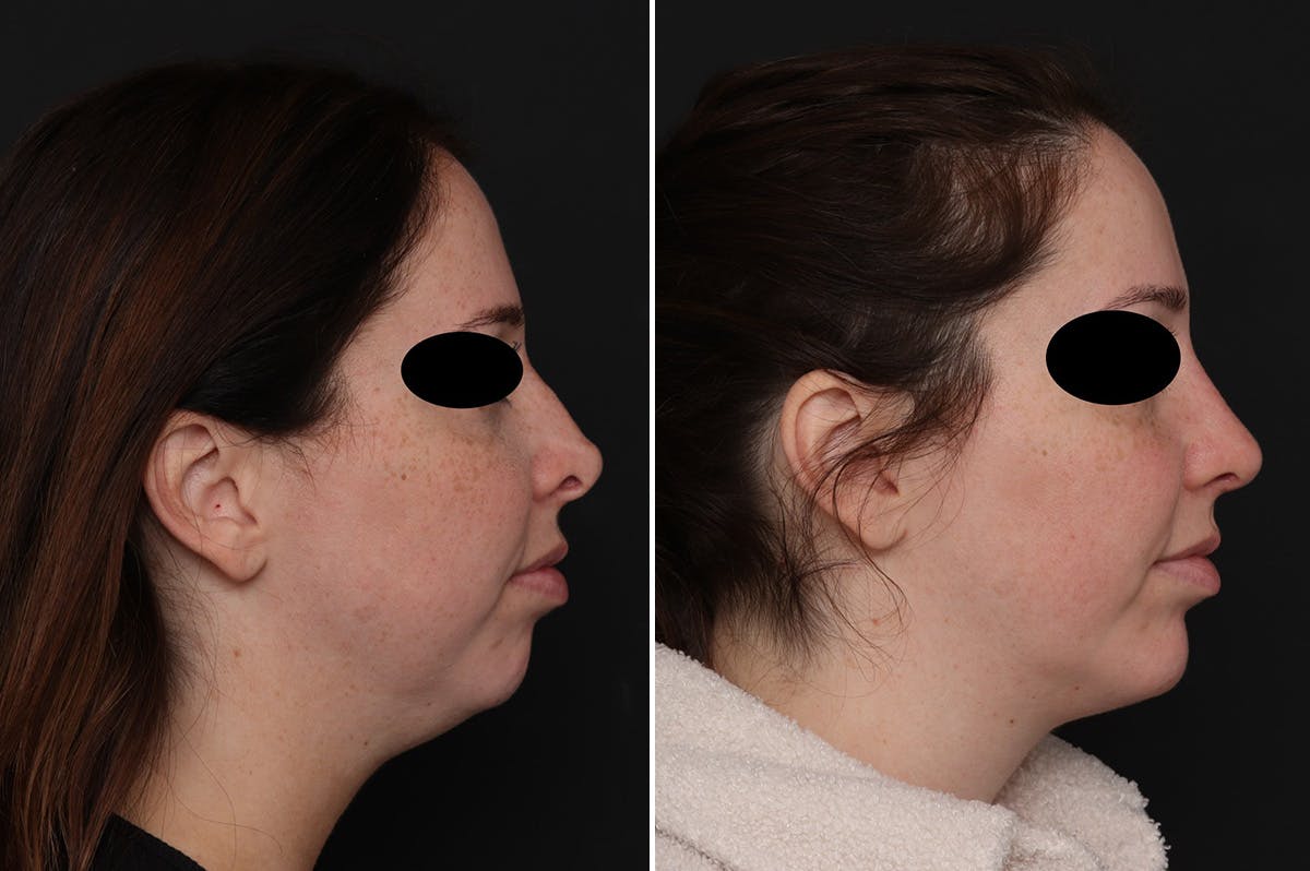 Chin Implants Before & After Gallery - Patient 222069 - Image 4