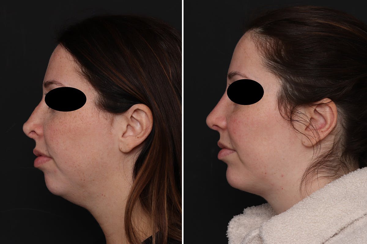 Chin Implants Before & After Gallery - Patient 222069 - Image 1