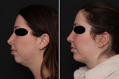 Revision Rhinoplasty Before & After Gallery - Patient 101156 - Image 1