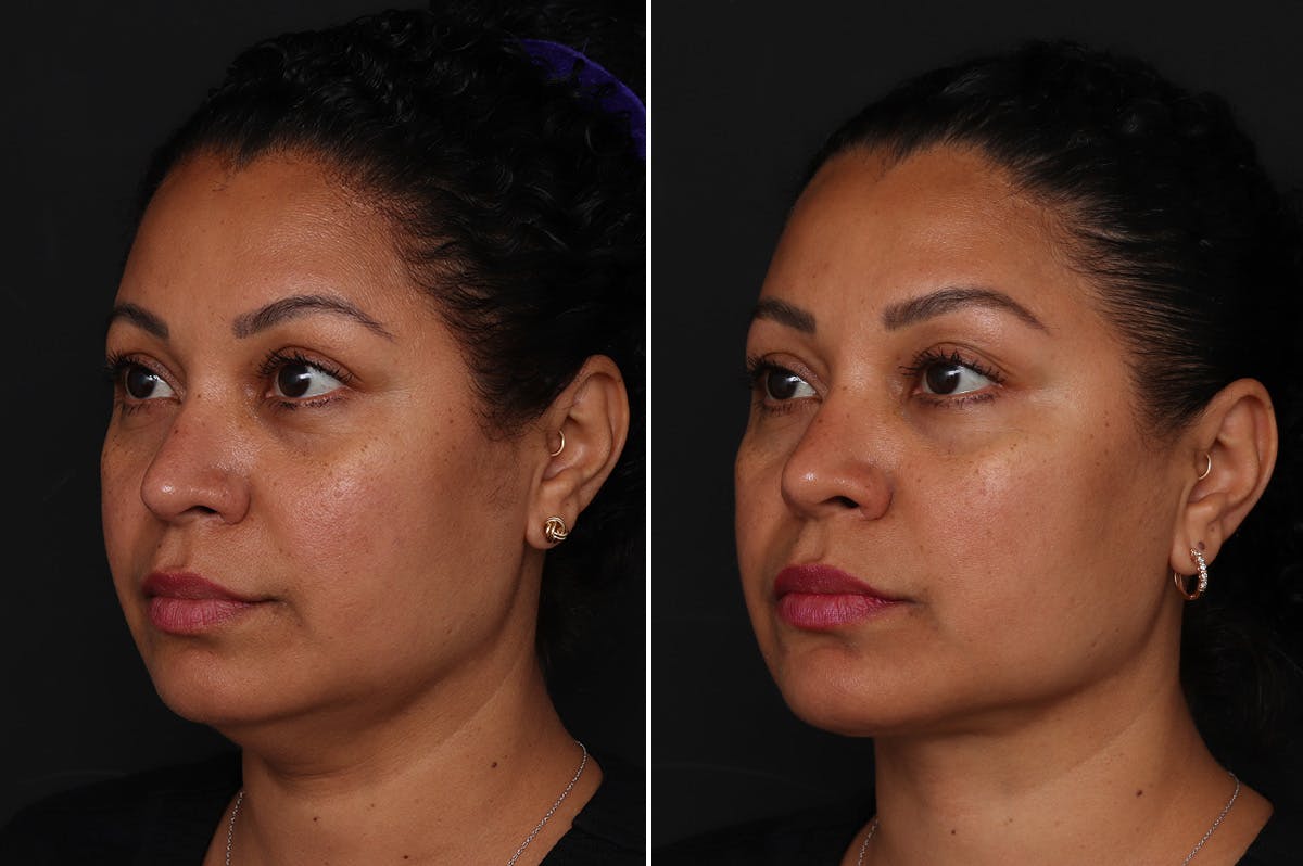 Neck Lift Before & After Gallery - Patient 305643 - Image 2