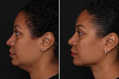 Neck Lift Before & After Gallery - Patient 305643 - Image 1