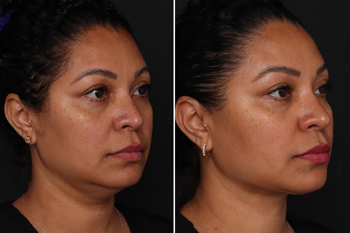 Neck Lift Before & After Gallery - Patient 305643 - Image 3