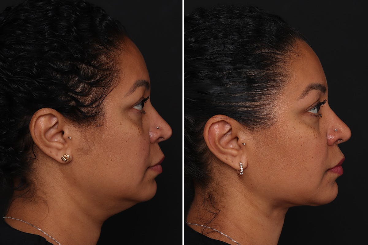 Neck Lift Before & After Gallery - Patient 305643 - Image 4