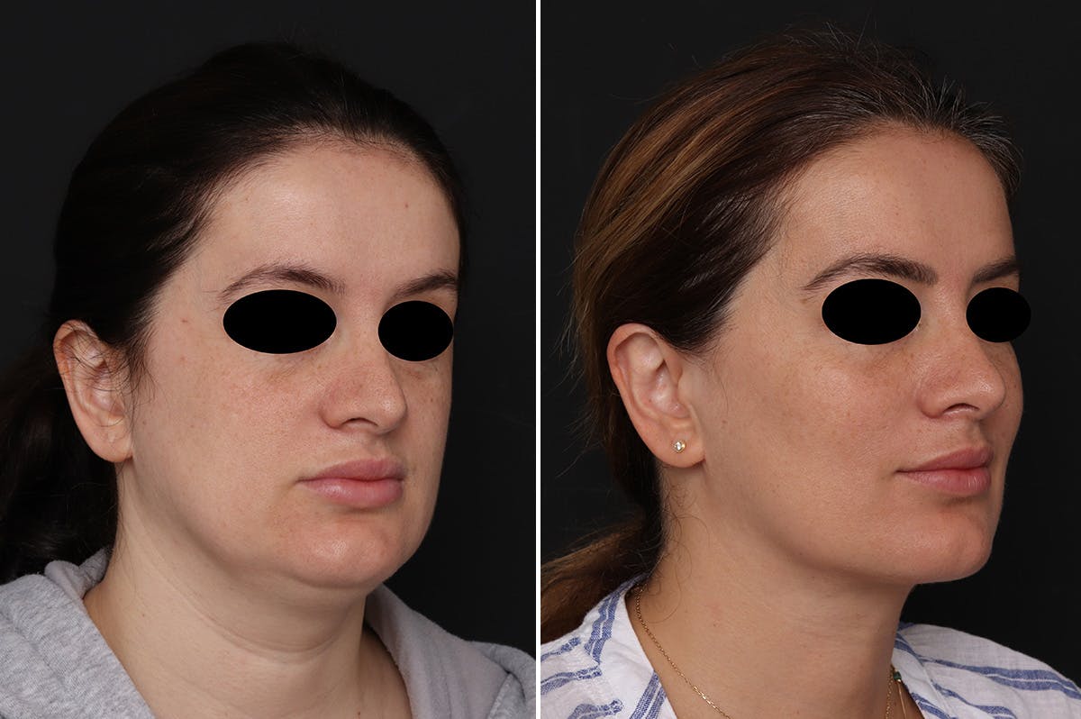 Neck Lift Before & After Gallery - Patient 752018 - Image 3