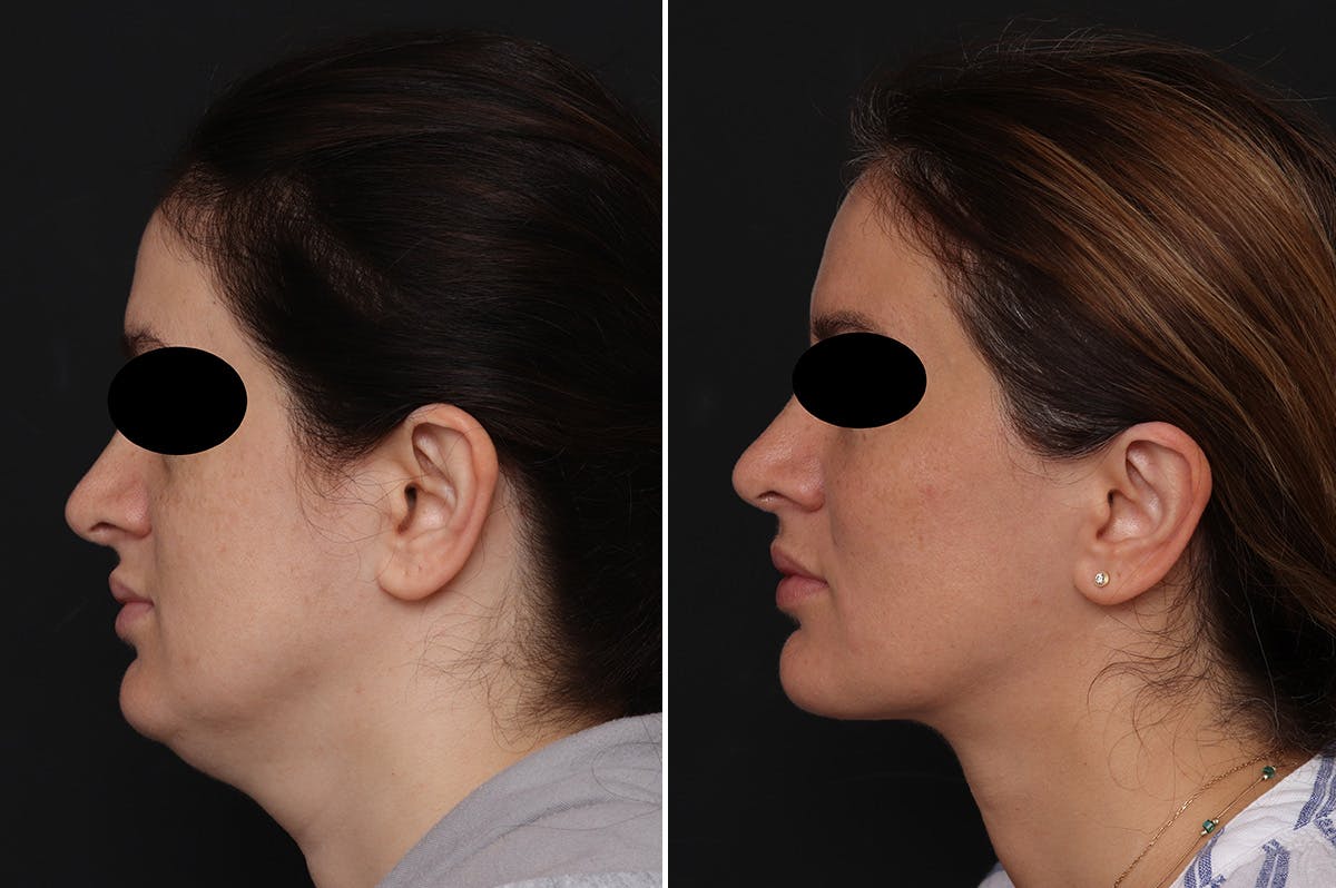 Neck Lift Before & After Gallery - Patient 752018 - Image 1