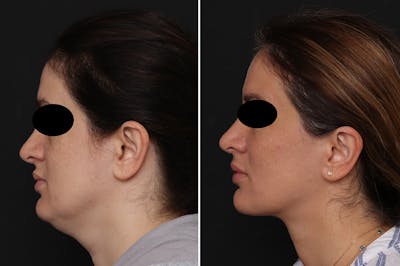 Neck Lift Before & After Gallery - Patient 752018 - Image 1