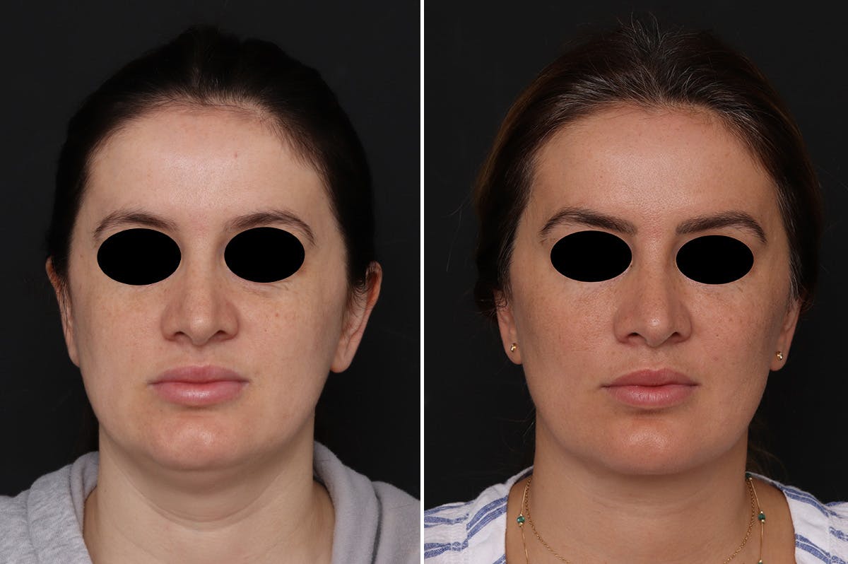 Neck Lift Before & After Gallery - Patient 752018 - Image 2