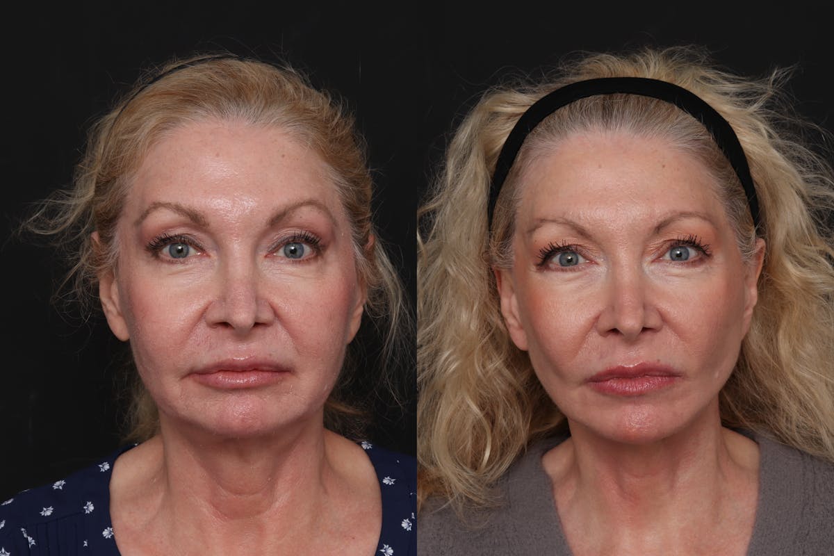 Facelift Before & After Gallery - Patient 125839 - Image 3