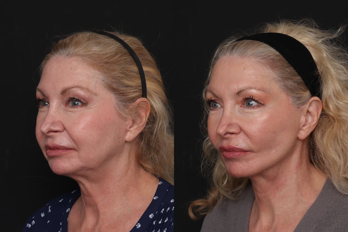 Facelift Before & After Gallery - Patient 125839 - Image 2