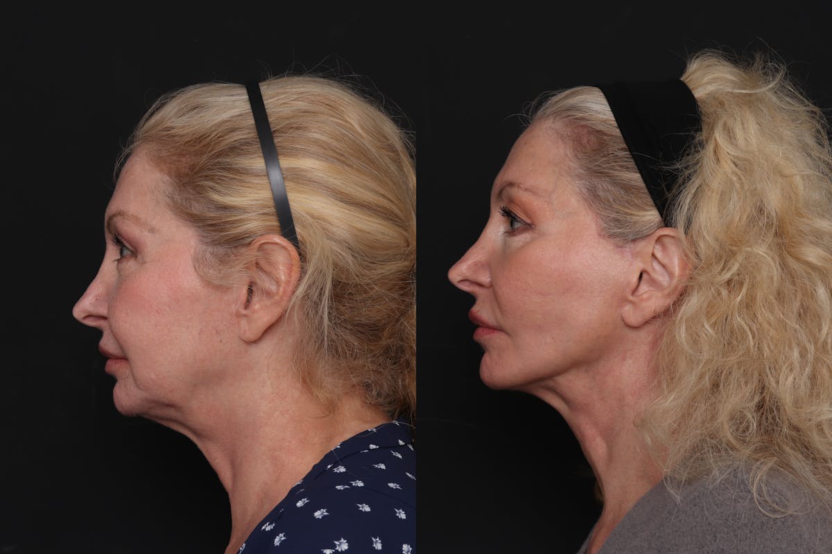 Facelift Before & After Gallery - Patient 125839 - Image 1