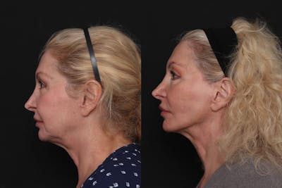 Facelift Before & After Gallery - Patient 125839 - Image 1