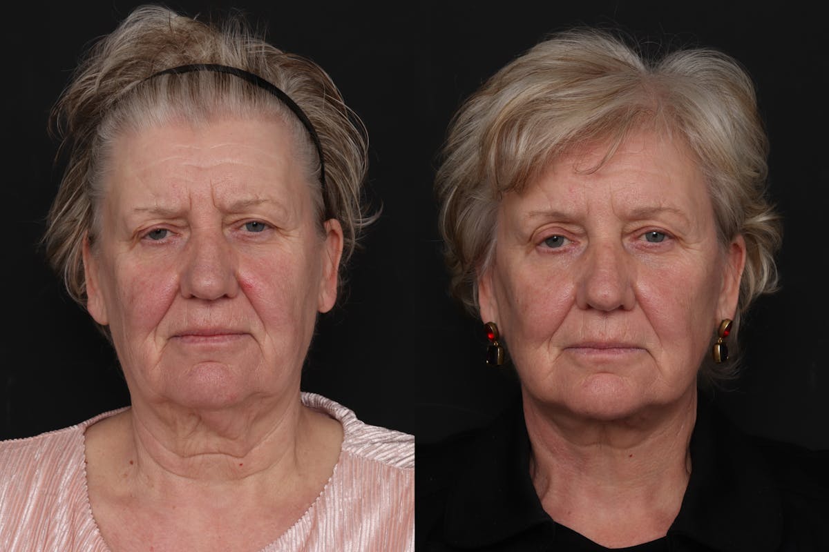 Facelift Before & After Gallery - Patient 133865 - Image 3