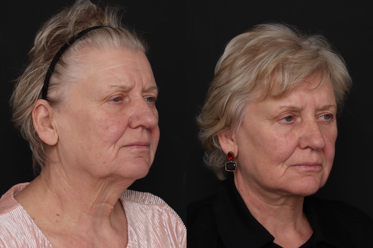 Facelift Before & After Gallery - Patient 133865 - Image 2