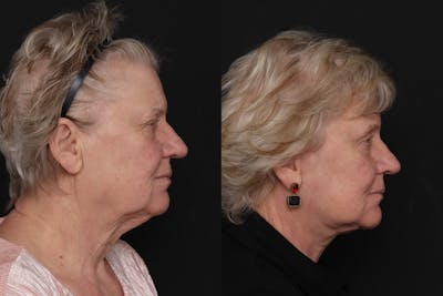 Facelift Before & After Gallery - Patient 133865 - Image 1