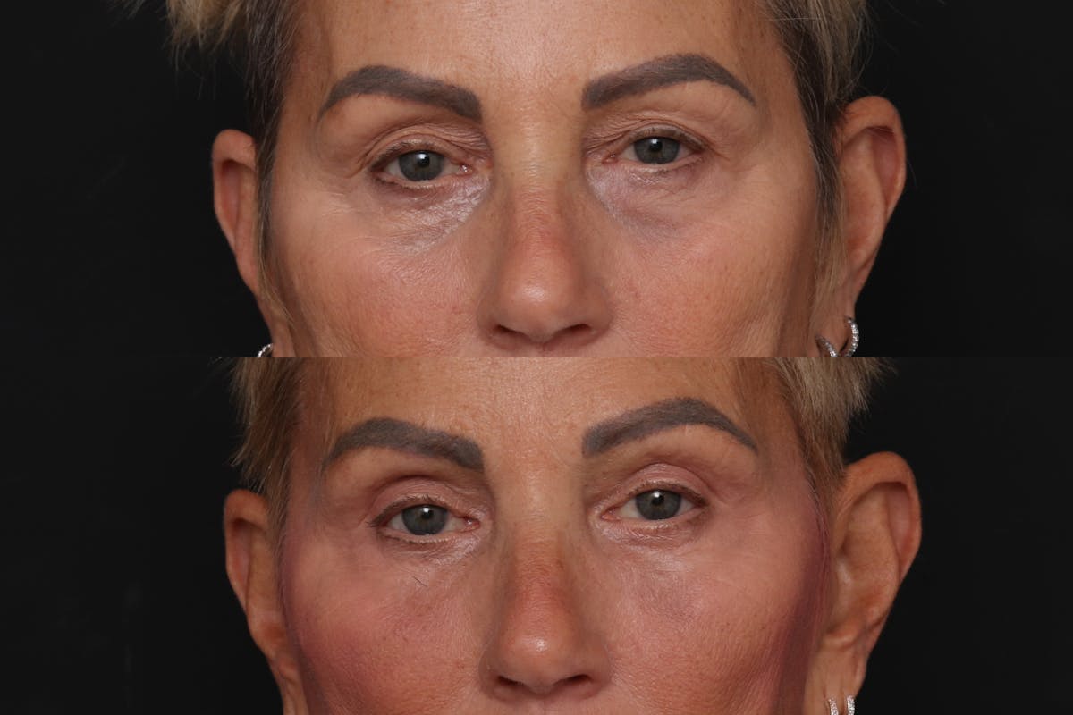 Fat Transfer Before & After Gallery - Patient 128199 - Image 1