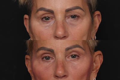 Upper Eyelid Before & After Gallery - Patient 346183 - Image 1