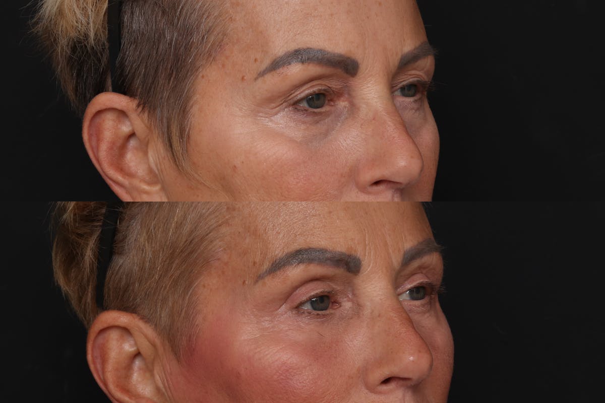 Fat Transfer Before & After Gallery - Patient 128199 - Image 2