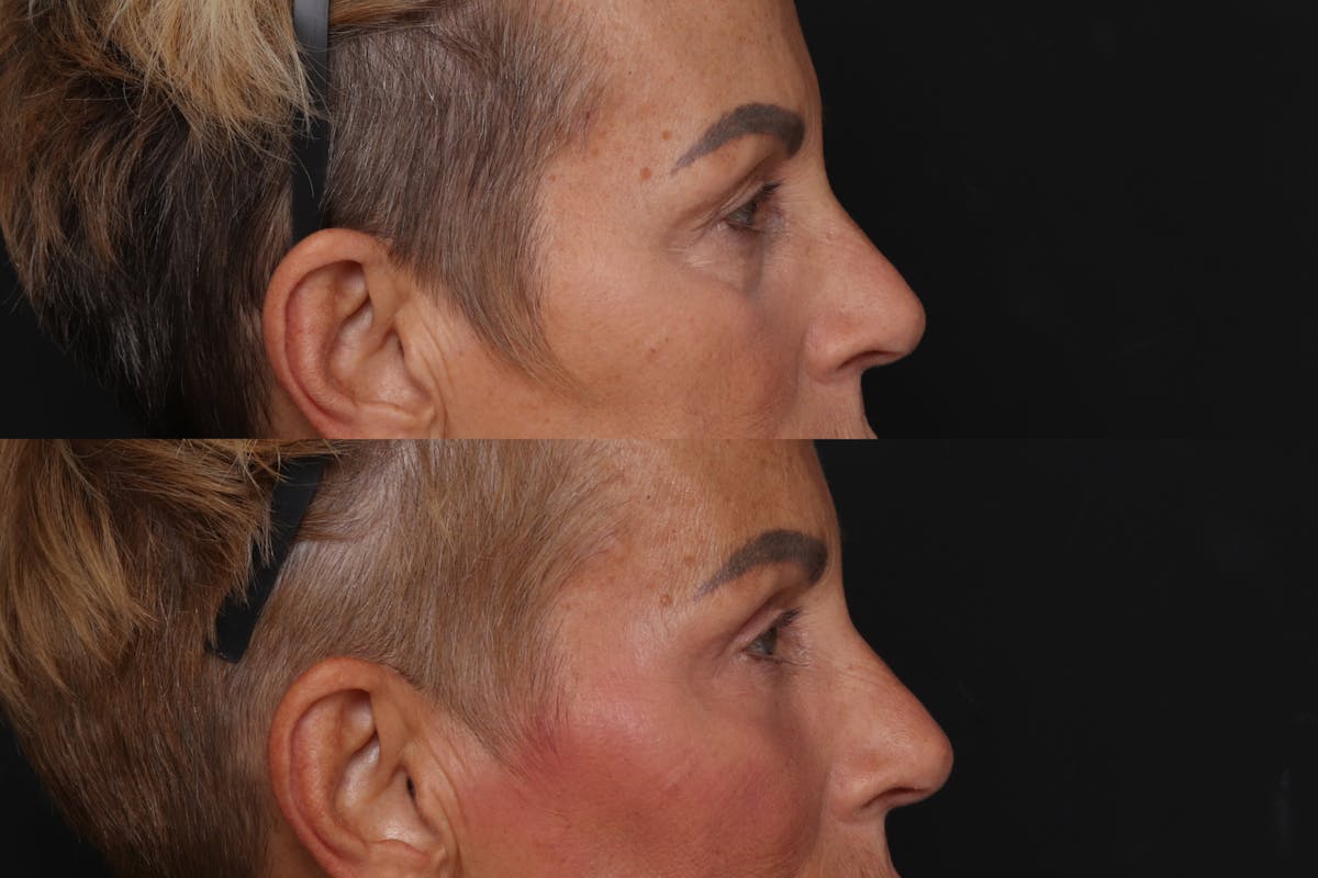 Fat Transfer Before & After Gallery - Patient 128199 - Image 3