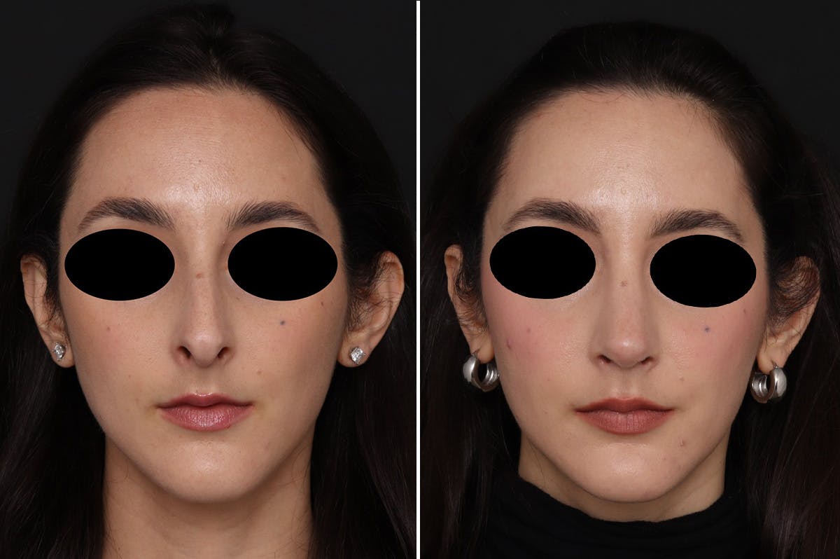 Rhinoplasty Before & After Gallery - Patient 366534 - Image 4