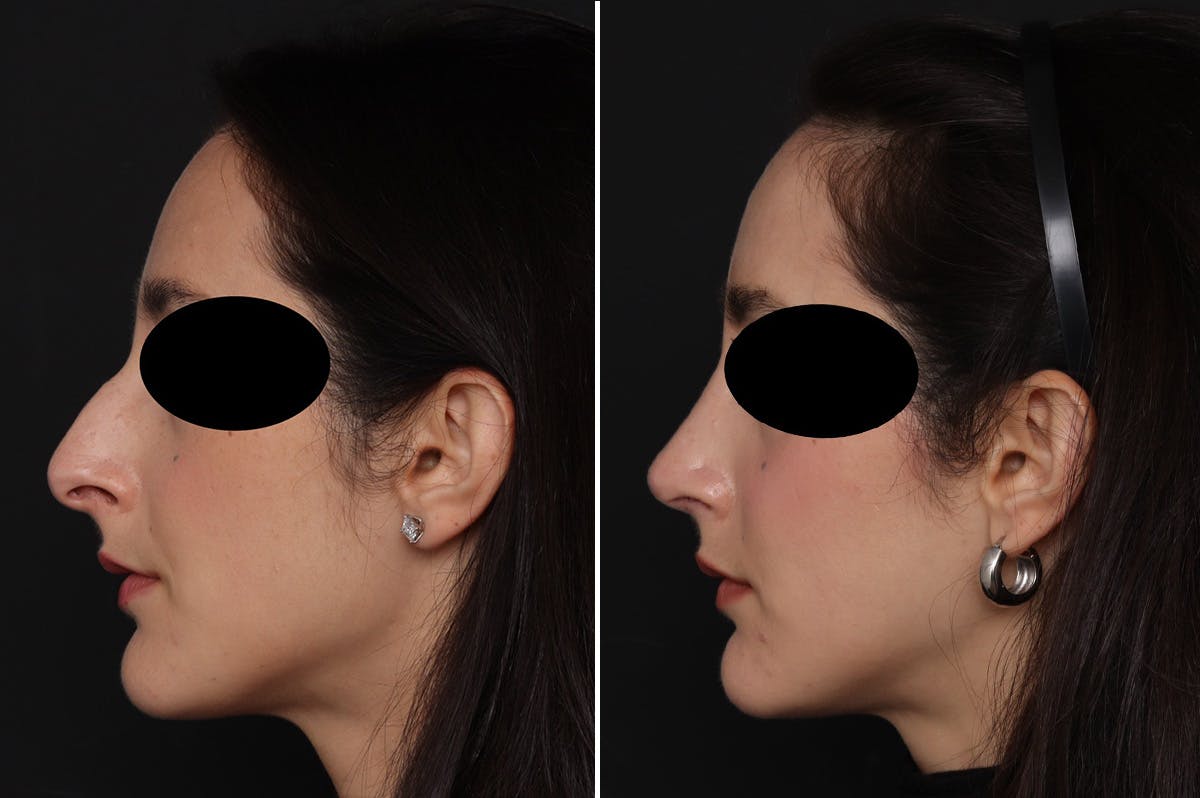 Rhinoplasty Before & After Gallery - Patient 366534 - Image 1