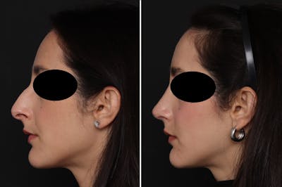 Rhinoplasty Before & After Gallery - Patient 366534 - Image 1
