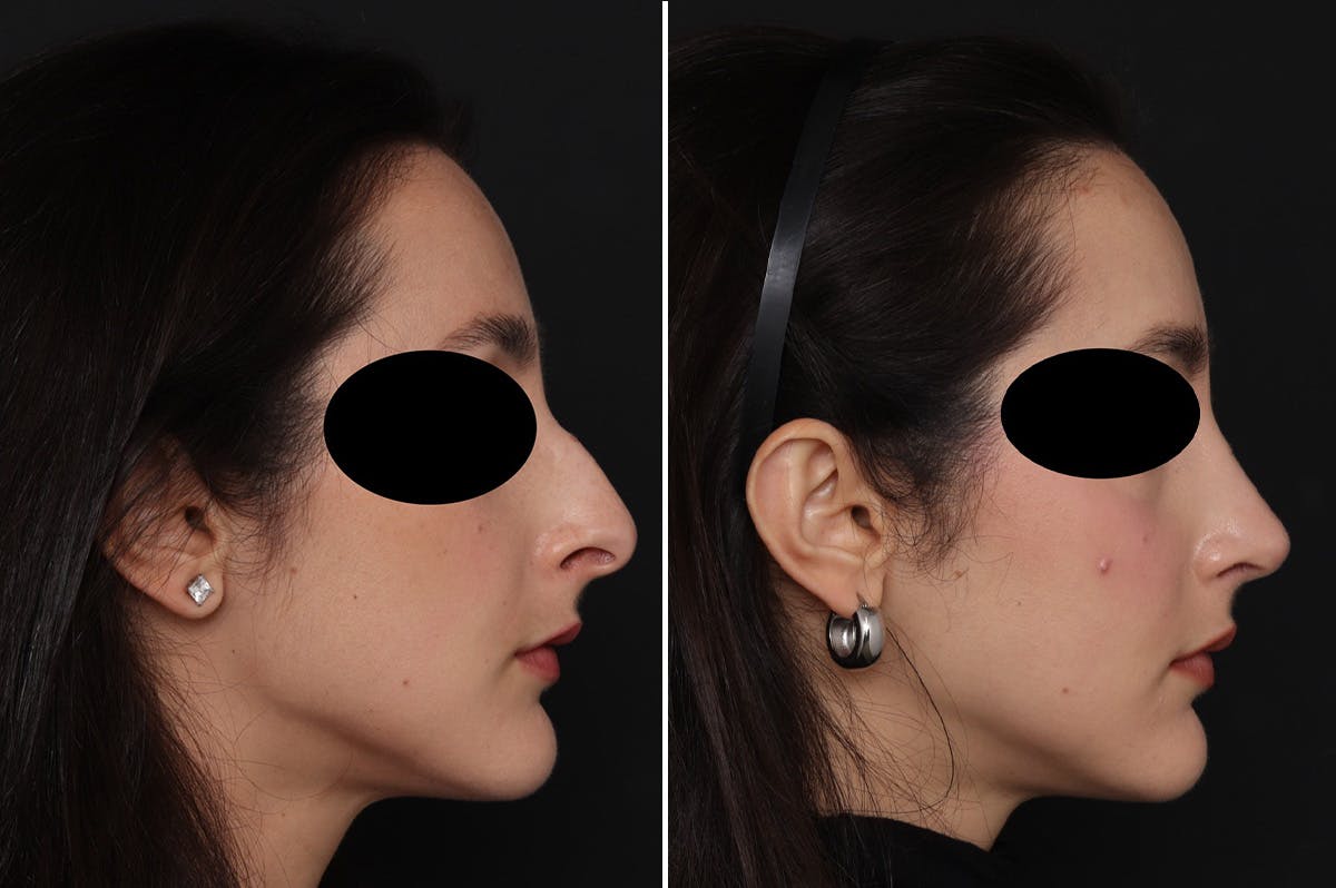 Rhinoplasty Before & After Gallery - Patient 366534 - Image 2