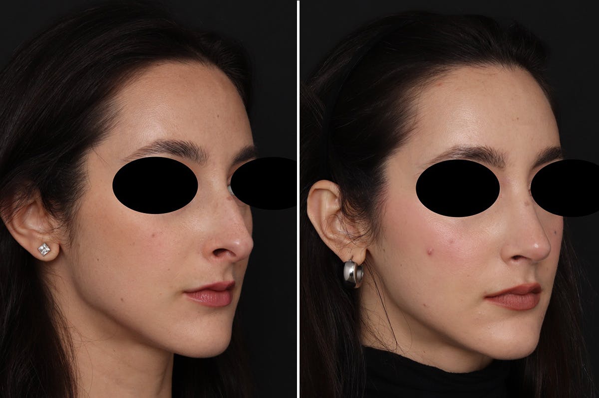 Rhinoplasty Before & After Gallery - Patient 366534 - Image 3