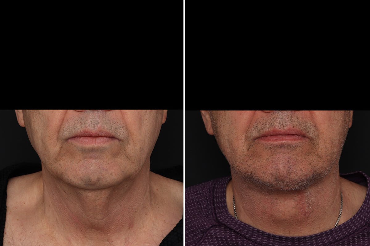 Neck Lift Before & After Gallery - Patient 286411 - Image 3