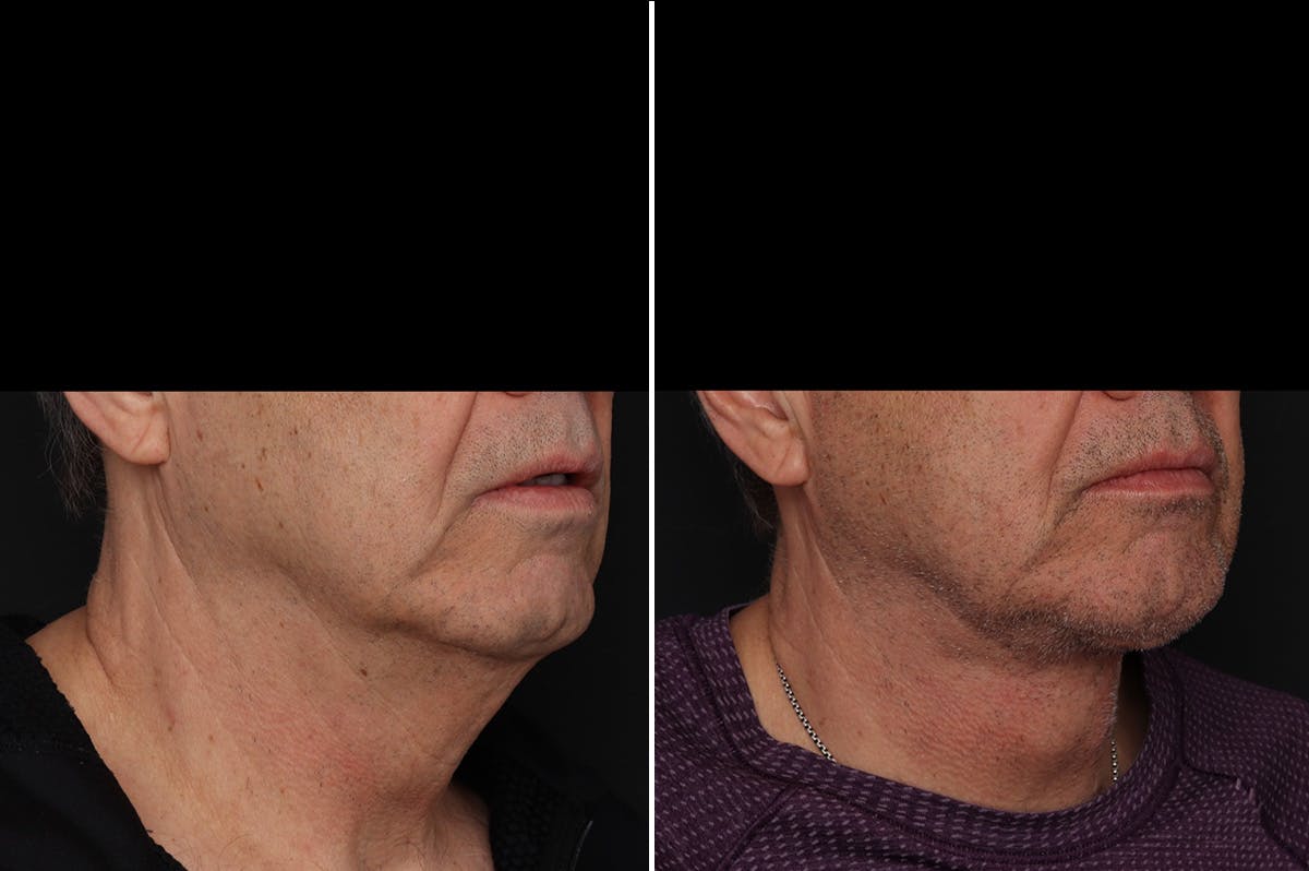 Neck Lift Before & After Gallery - Patient 286411 - Image 4