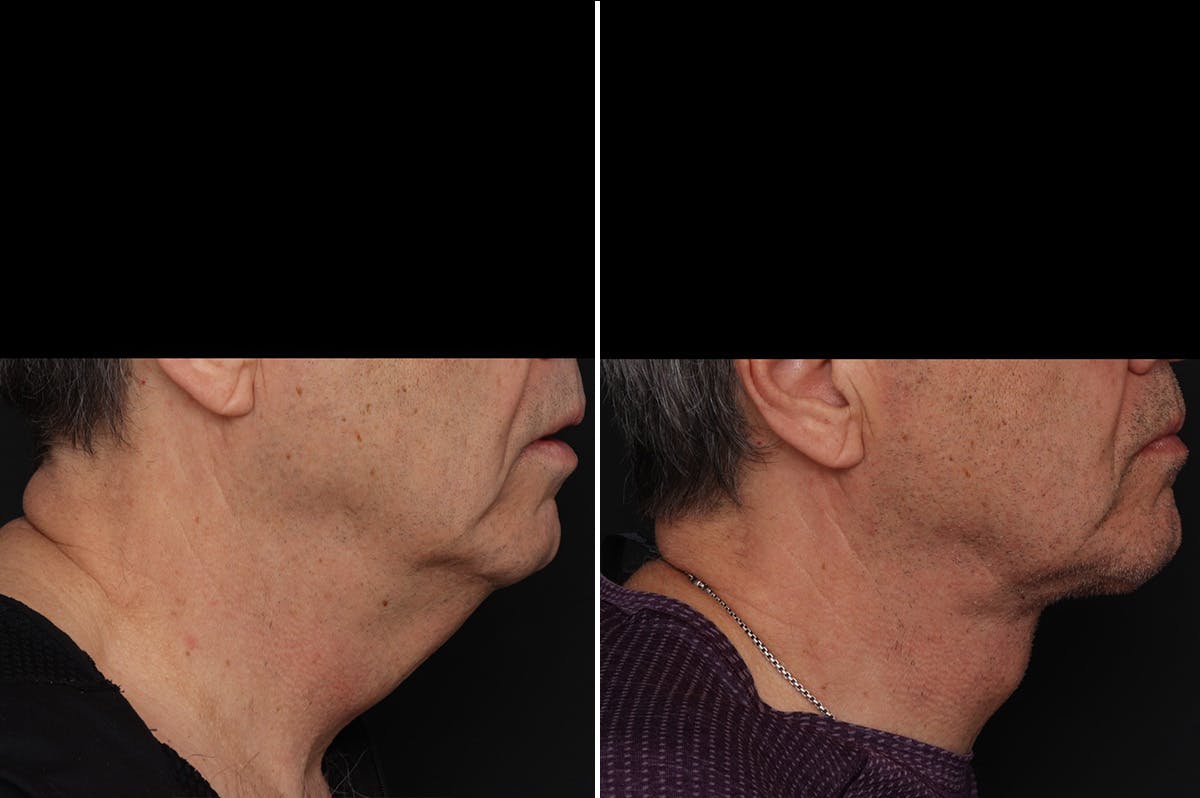 Neck Lift Before & After Gallery - Patient 286411 - Image 5
