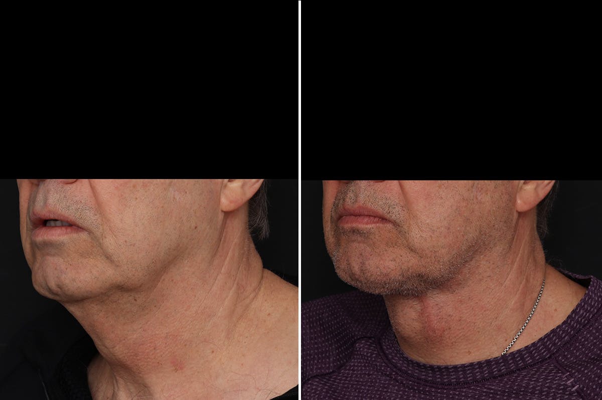 Neck Lift Before & After Gallery - Patient 286411 - Image 2