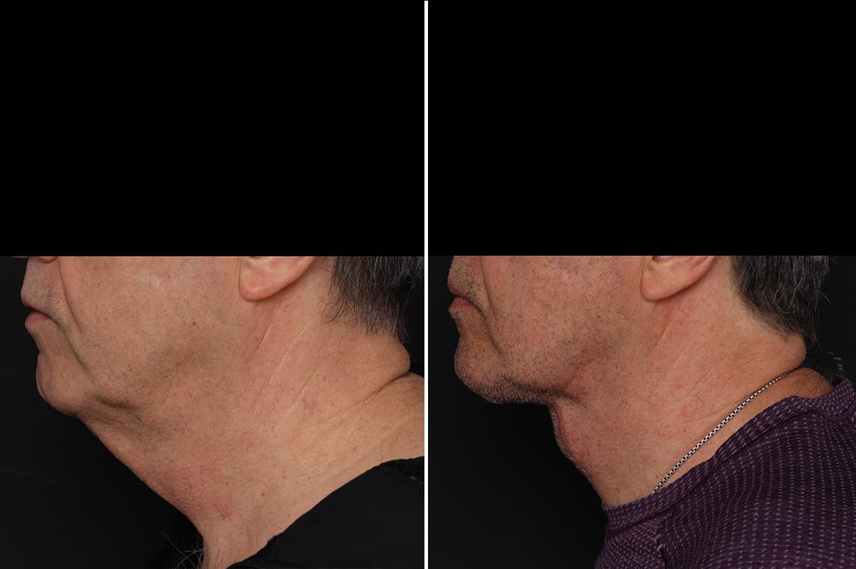 Neck Lift Before & After Gallery - Patient 286411 - Image 1