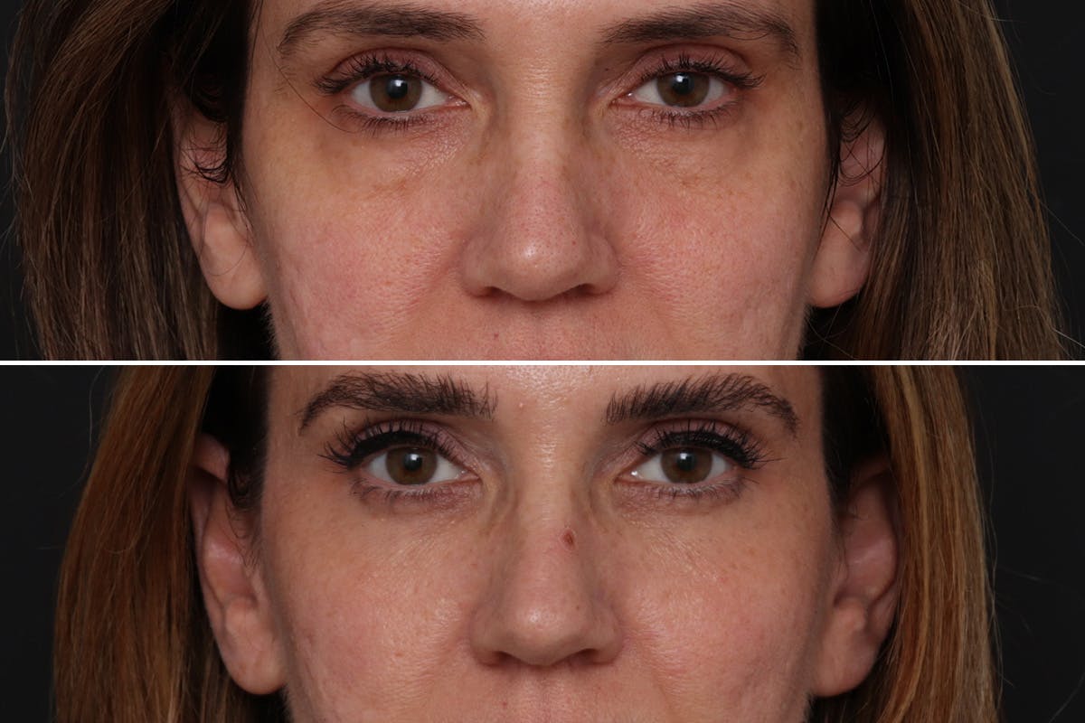 Lower Eyelid Before & After Gallery - Patient 985066 - Image 1