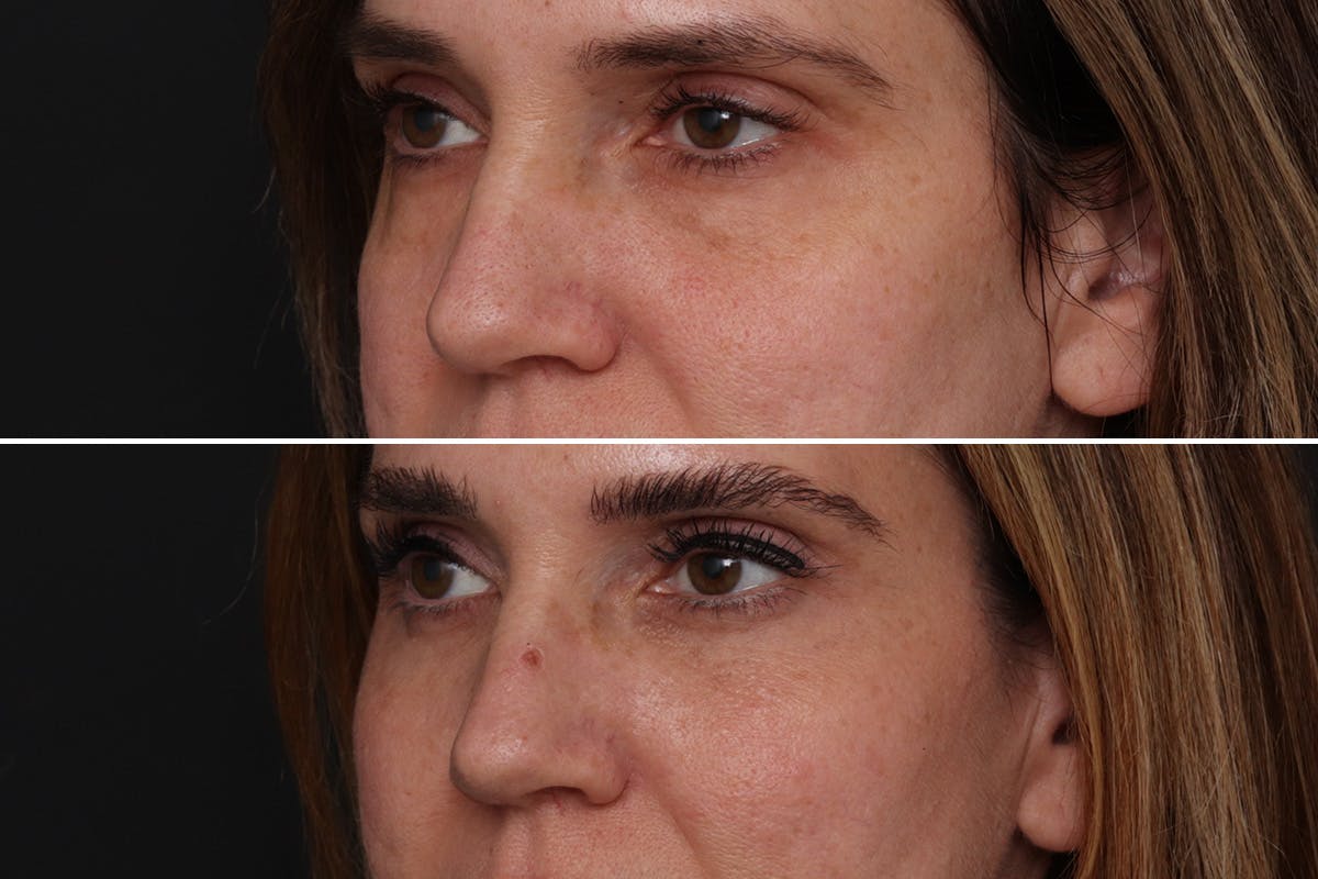 Lower Eyelid Before & After Gallery - Patient 985066 - Image 2