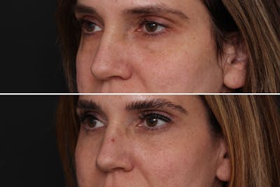 Fat Transfer Before & After Gallery - Patient 176498 - Image 1