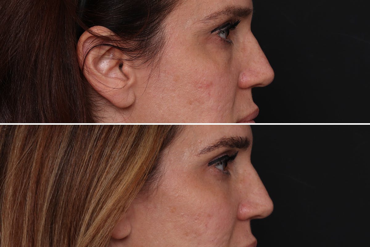 Lower Eyelid Before & After Gallery - Patient 985066 - Image 4