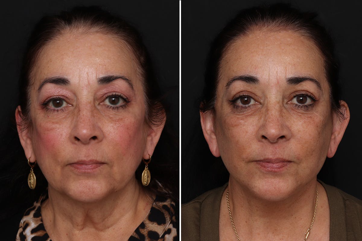 Facelift Before & After Gallery - Patient 230818 - Image 3