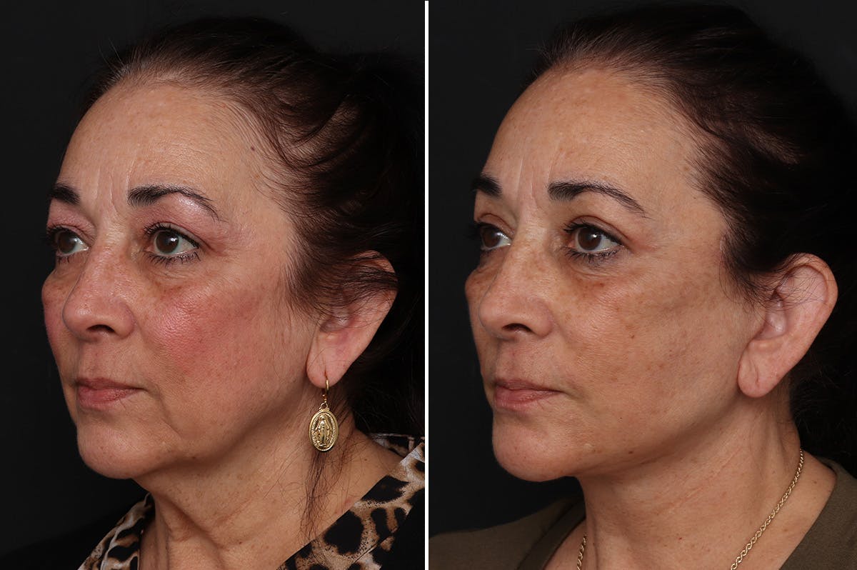 Facelift Before & After Gallery - Patient 230818 - Image 2