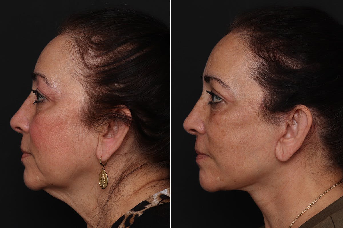 Facelift Before & After Gallery - Patient 230818 - Image 1