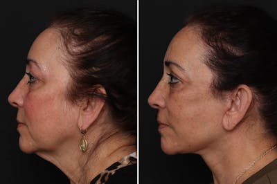 Facelift Before & After Gallery - Patient 230818 - Image 1