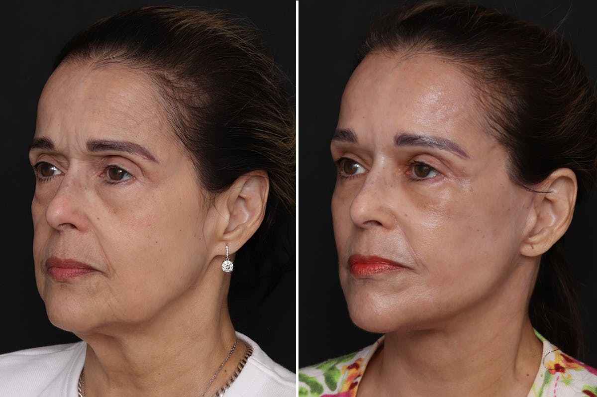 Facelift Before & After Gallery - Patient 109698 - Image 2