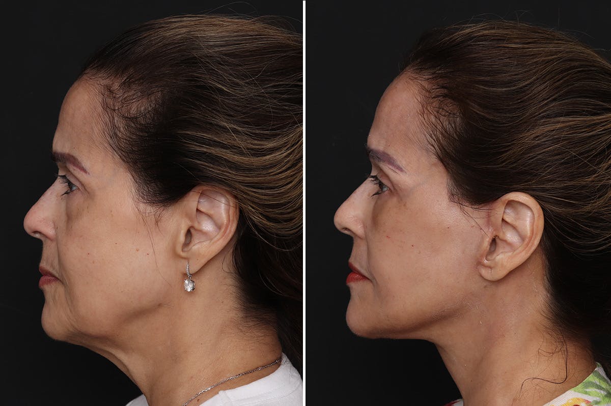 Facelift Before & After Gallery - Patient 109698 - Image 1