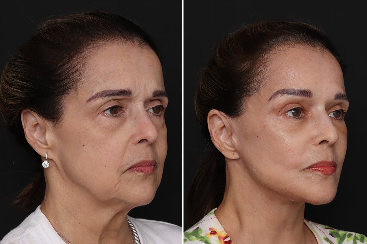 Facelift Before & After Gallery - Patient 109698 - Image 3
