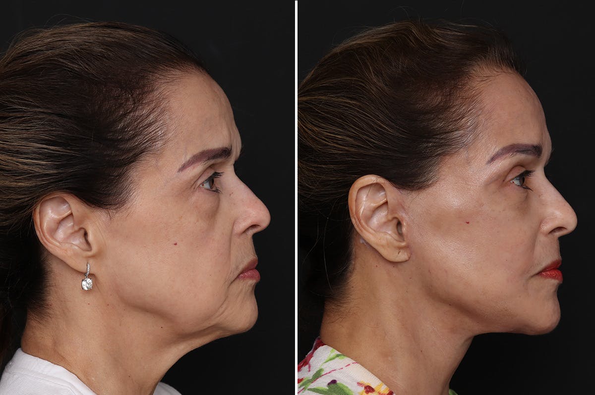 Facelift Before & After Gallery - Patient 109698 - Image 4