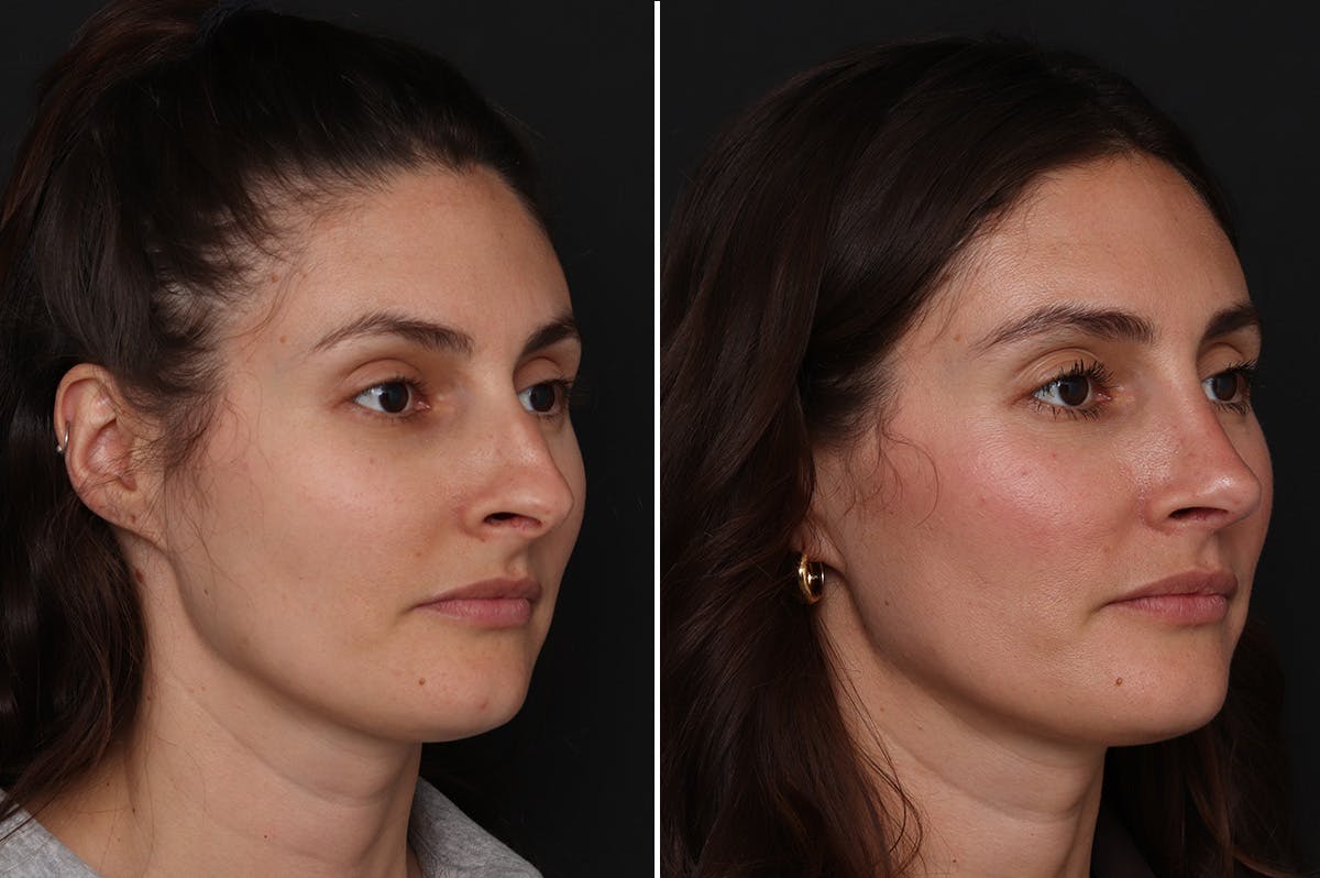 Rhinoplasty Before & After Gallery - Patient 111886 - Image 1